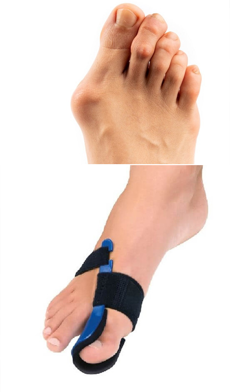 halluxvalgus